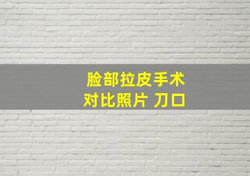 脸部拉皮手术对比照片 刀口